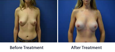 View-Our-Breast-Augmentation-Before-And-After-Results