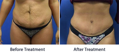 View-Our-Tummy-Tuck-Before-And-After-Results