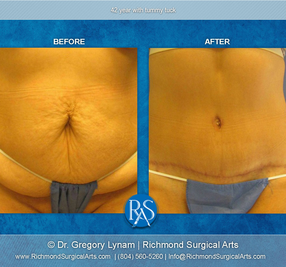 Tummy Tuck in Chelmsford - Plastic Surgery Chelmsford, MA