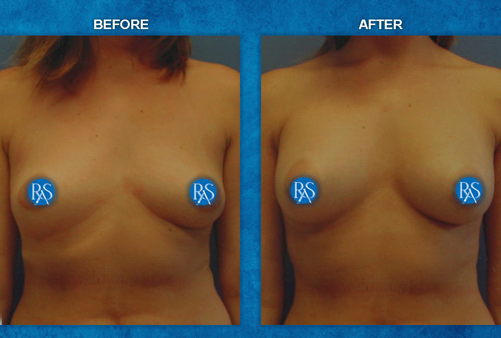 250cc moderate profile saline implants with armpit incision