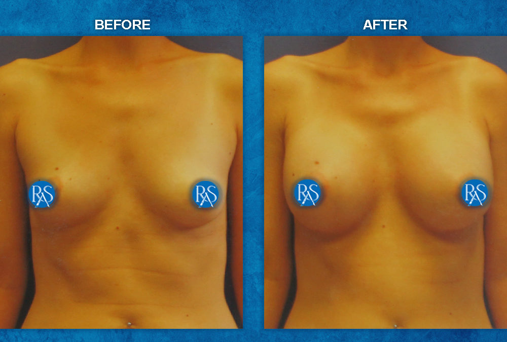 330cc Saline No breast scar augmentation HP