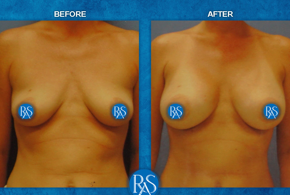 Before and 3 months after silicone breast implants