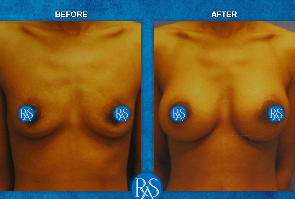 350cc saline high profile implants No Breast Scar