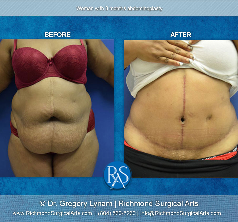 Eliminating A Bulging Belly With A Tummy Tuck - Dr Hamid Our Surgical Team