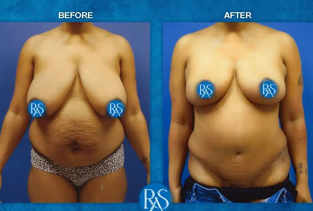 3 Months After Mommy Makeover