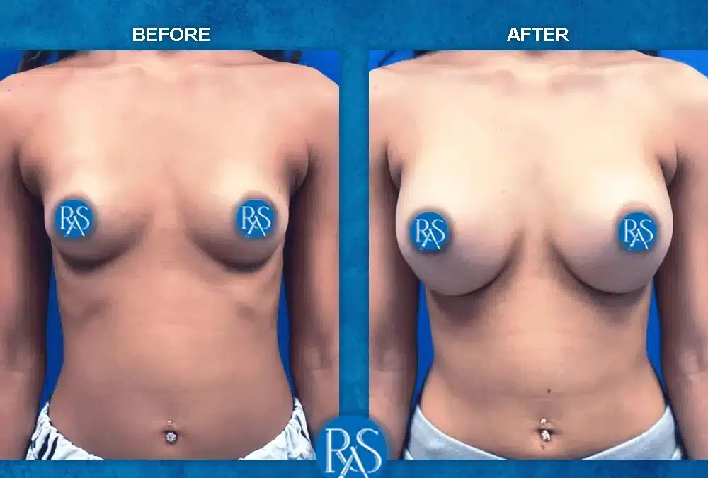 4 Months Post Op SSM 295cc
