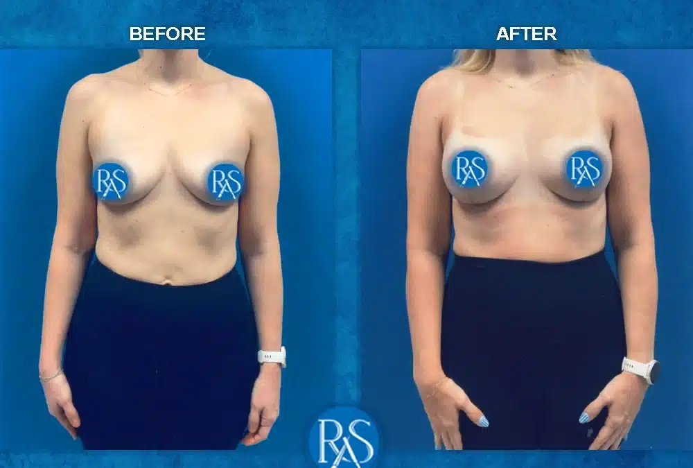 Motiva Ergo 360cc With Mastopexy 3 Months Post Procedure