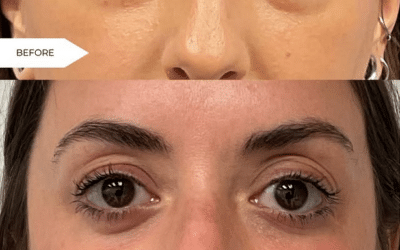 What Does a “Scarless” Eye Rejuvenation Actually Look Like? A Real Lower Blepharoplasty Case Study from Richmond, VA