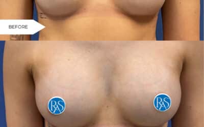 The beauty of a ballerina breast augmentation is in the balance